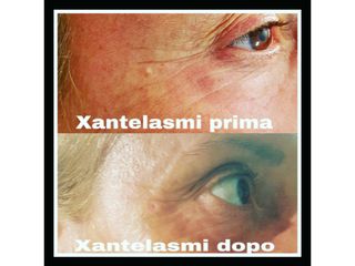 Xantelasmi prima e dopo