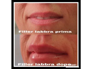 Filler labbra prima e dopo