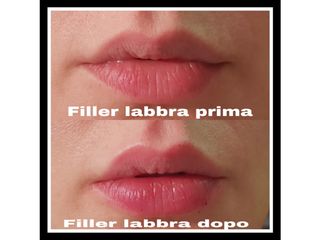 Filler labbra prima e dopo