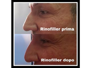 Rinofiller prima e dopo