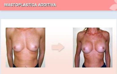mastoplastica additiva prima dopo
