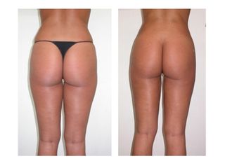 liposuzione prima dopo