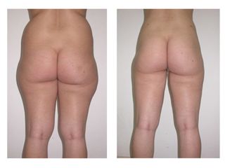 Liposuzione prima dopo