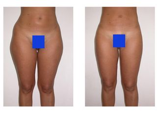 liposuzione prima dopo