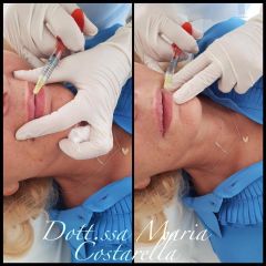 fillerlabbra