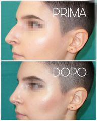 Rinoplastica - Dott. Dauro Reale