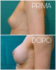 Mastoplastica additiva - Dott. Dauro Reale