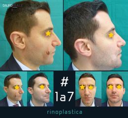 Rinoplastica - Dott. Dauro Reale
