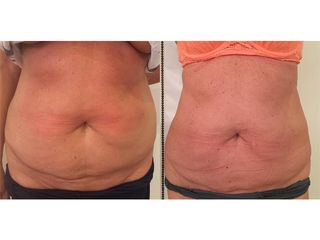 Velashape prima e dopo
