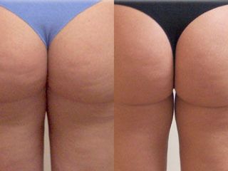 mesoterapia prima dopo