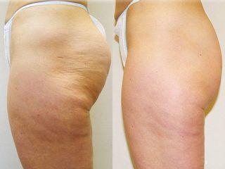 mesoterapia prima dopo