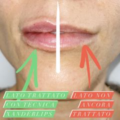 Filler labbra - Dott. Alessandro Pasquali