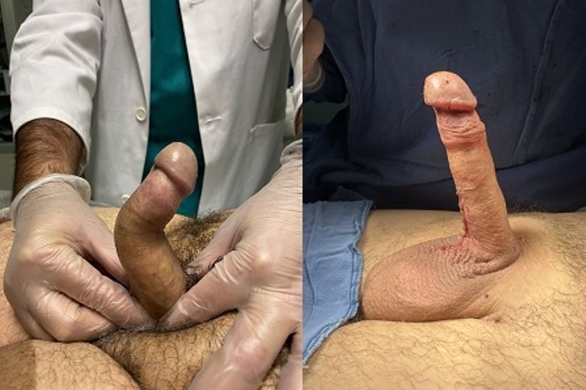 Allungamento pene prima e dopo - 863091