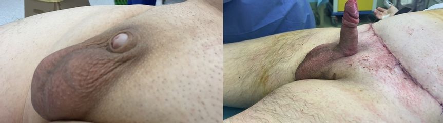 Dermolipectomia e allungamento