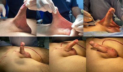 Falloplastica di allungamento con  incisione vy con scrotoplastica
