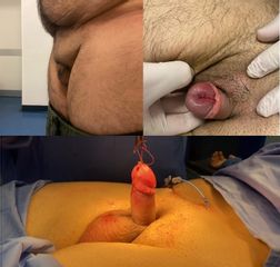 Falloplastica di allungamento con lipectomia in paziente affetto da Epispadia