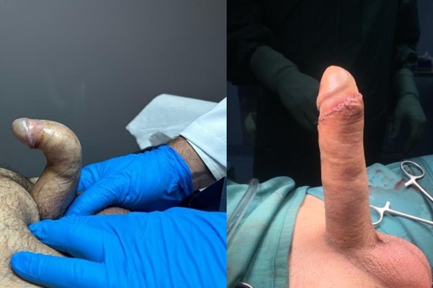 Allungamento pene prima e dopo - 863105
