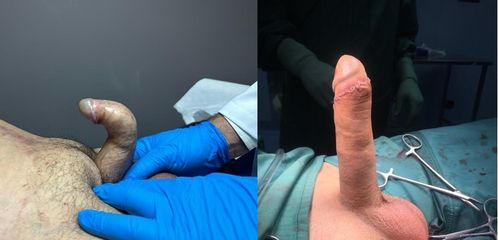 Falloplastica di allungamento con protesi e patch