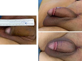 Ingrossamento pene prima e dopo - 863107