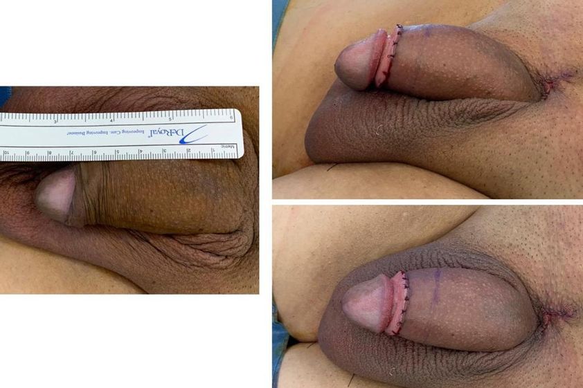 Ingrossamento pene prima e dopo - 863107