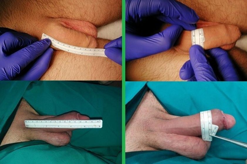 Allungamento pene prima e dopo - 863110