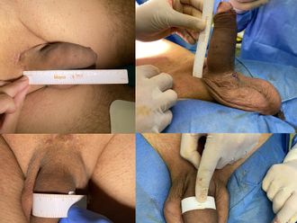 Ingrossamento pene prima e dopo - 863112