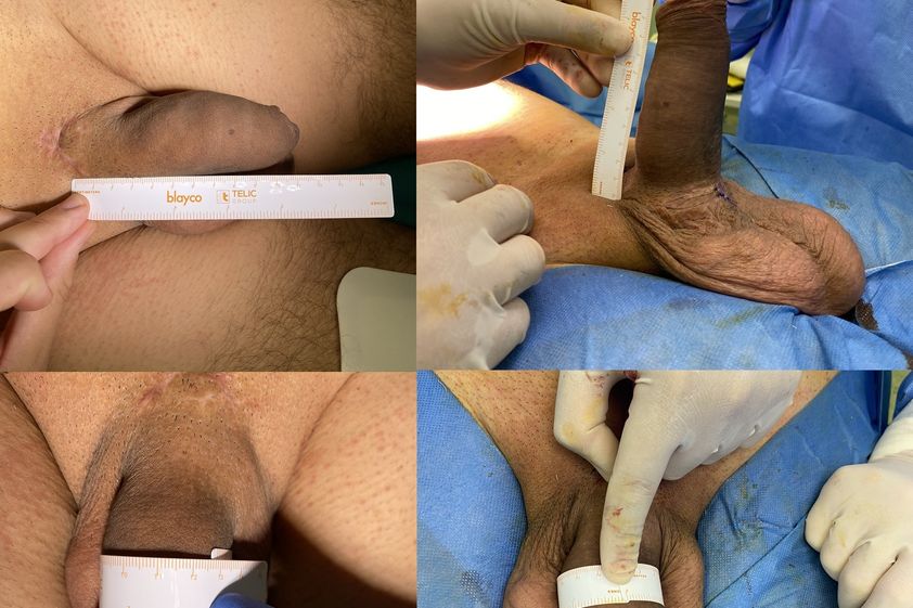 Ingrossamento pene prima e dopo - 863112