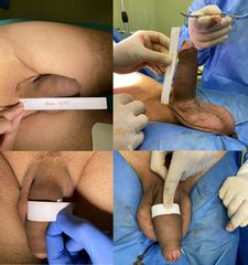 Falloplastica di allungamento ed ingrossamento con  lipofilling