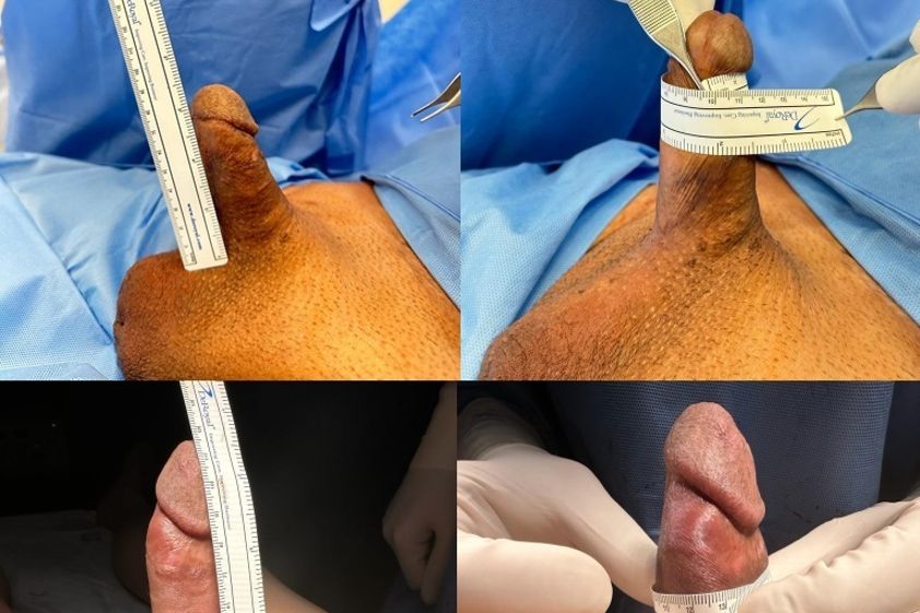 Allungamento pene prima e dopo - 863116