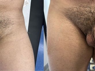 Ingrossamento pene prima e dopo - 863118