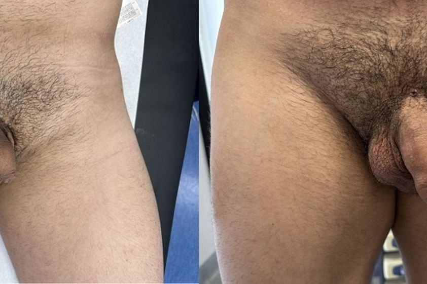 Ingrossamento pene prima e dopo - 863118