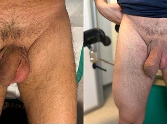 Ingrossamento pene prima e dopo - 863119