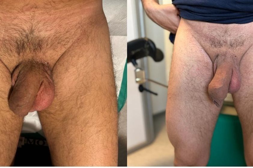Ingrossamento pene prima e dopo - 863119