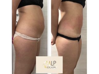 Radiofrequenza - MLP MedicalSpa
