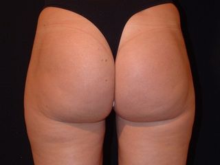 Liposuzione post trattamento