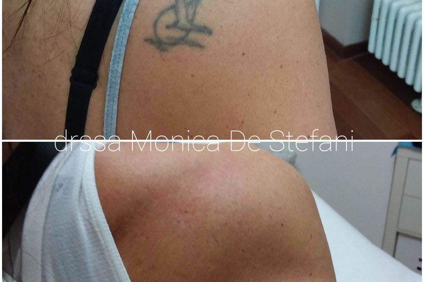 Laserterapia prima e dopo - 770768