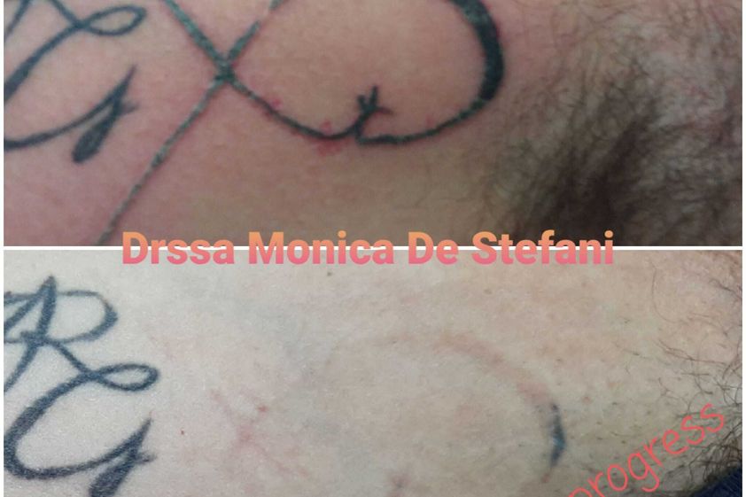 Rimozione tatuaggi prima e dopo - 774928