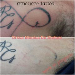 Rimozione tatuaggi - Studio Medico De Stefani