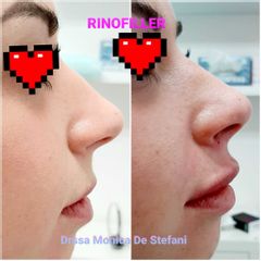Rinofiller - Studio Medico De Stefani