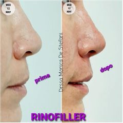 Rinofiller - Studio Medico De Stefani