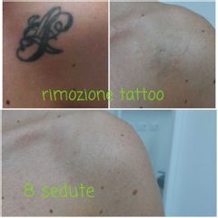 Rimozione tatuaggi - Studio Medico Drssa De Stefani