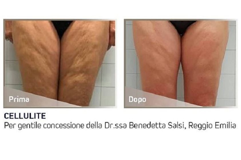 Cellulite prima e dopo - 823515