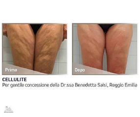 Cellulite - Studio medico Monica De Stefani