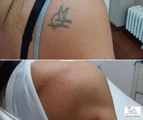 Rimozione tatuaggi - Studio medico Monica De Stefani