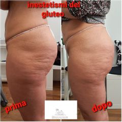 Cellulite -Studio medico Monica De Stefani