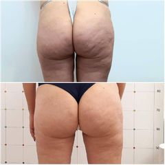 Cellulite - Studio medico Monica De Stefani