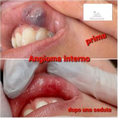 Angioma - Studio medico Monica De Stefani