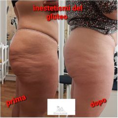 Cellulite - Studio medico Monica De Stefani