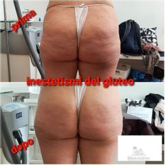 Cellulite - Studio medico Monica De Stefani