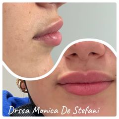 Filler labbra  - Studio medico Monica De Stefani